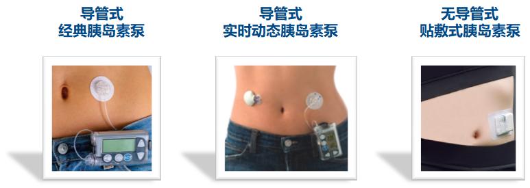 2021年胰岛素泵使用指南,2017中国糖尿病胰岛素治疗指南
