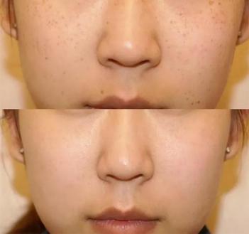 25岁脸上有斑用什么平价护肤品,脸上有斑气色差用什么护肤品