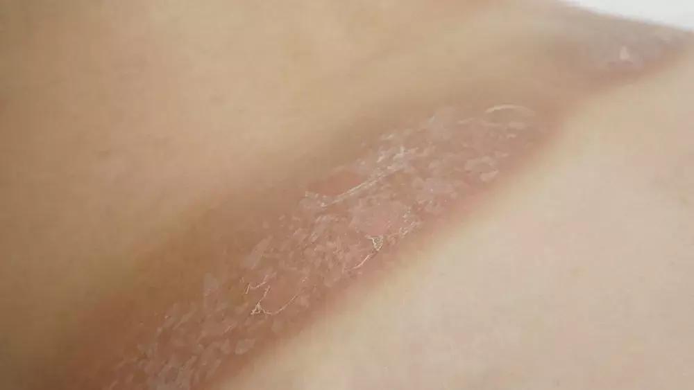 晒黑后如何快速变白,额头晒黑怎么快速变白