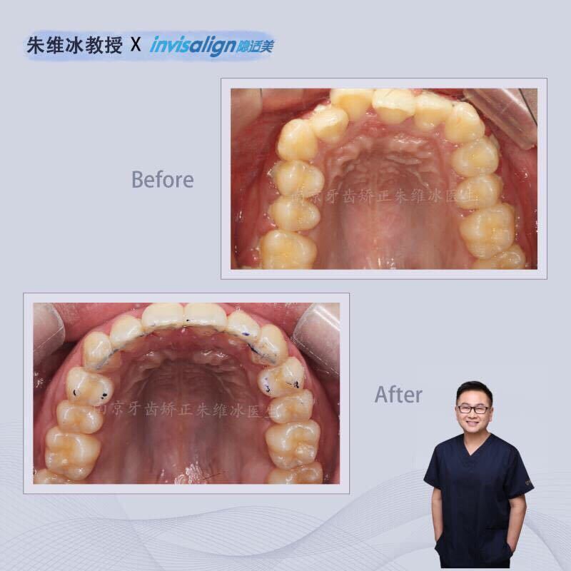 隐适美牙齿拥挤矫正真实案例,南京朱维冰