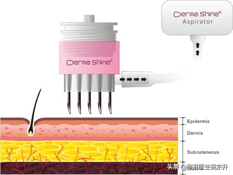 水光针面膜真的有用吗,打水光针为什么要面膜