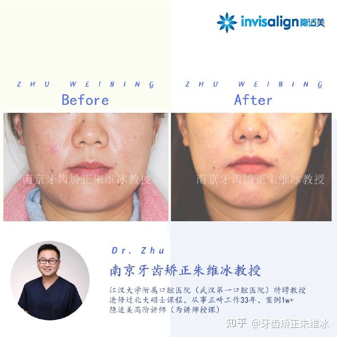 南京牙齿矫正骨性嘴凸案例,郑州牙齿矫正会让脸型更好看吗