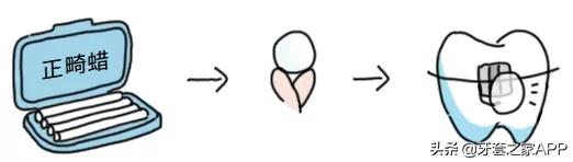 疫情时牙套遇到突发情况怎么办？应对办法在这里