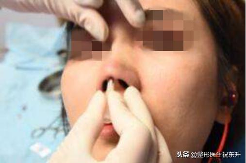 红色预警发出后规定的防范措施,哪些鼻型不适合线雕隆鼻