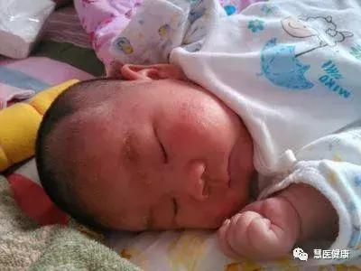 宝宝湿疹和痱子的区别和治疗方法,宝宝痱子湿疹怎么消除效果好