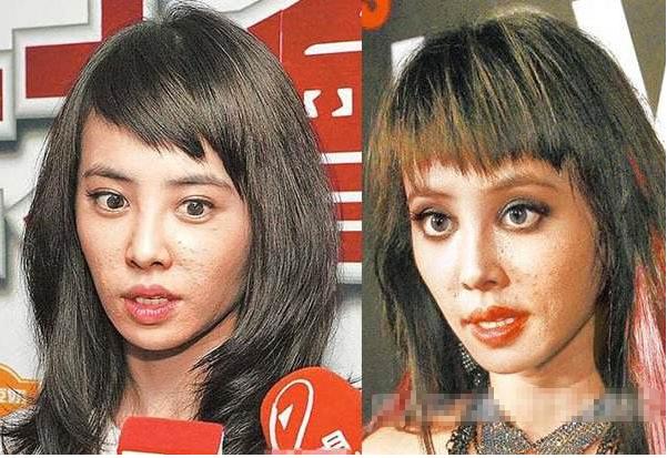 如何快速祛痘:痘痘分四个等级,你属于哪一级?