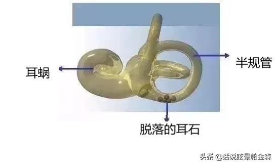 耳石症与新冠肺炎,耳石症和冠心病有联系吗