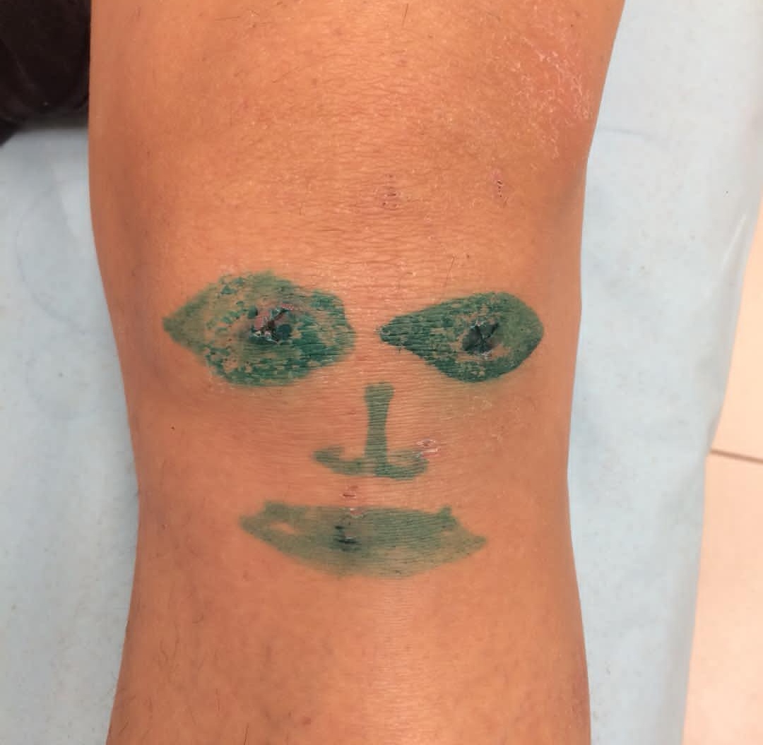 膝盖有骨刺和关节炎怎么治疗最好,膝关节长骨刺一冷就疼怎么治疗