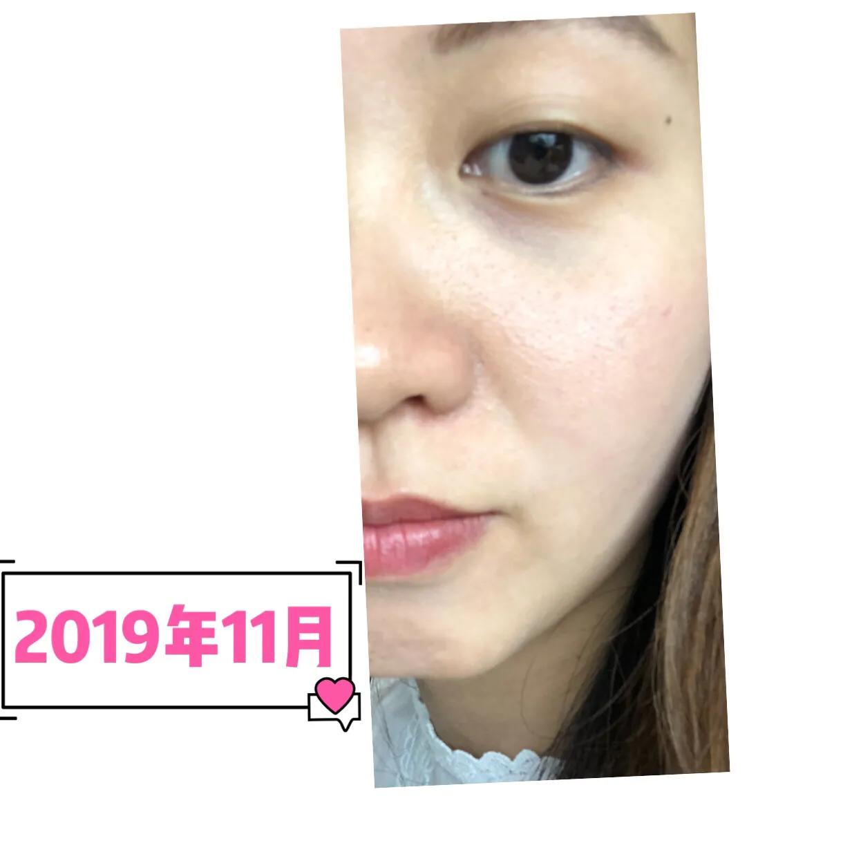 与病魔对抗的第30天,激素脸排毒第31天