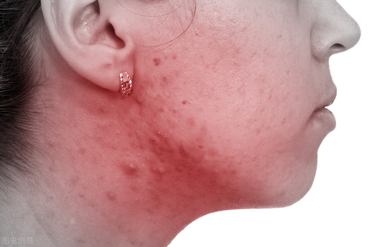 疮疤性痤疮,丘疹型玫瑰疮怎么治