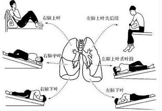 支气管扩张的体位引流如何做,支气管扩张体位引流