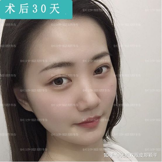 刚割双眼皮的样子,割双眼皮增生是什么样子