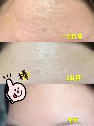 ​建议皮肤“坑洼”的女生，多在这件事花功夫，脸上净爽还更嫩了