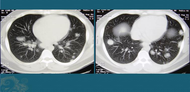 32岁肺部ct报告小结节7mm,28岁查出肺结节