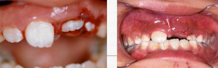 3岁小孩牙齿要怎么保护,儿童牙齿外伤需要检查什么