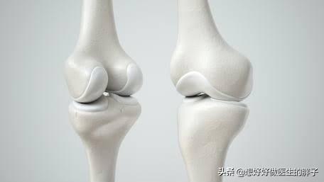 辟谣膝关节,年轻人膝盖有骨刺能根治吗