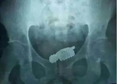 【惨痛】泸州小伙尿道里取出4个异物