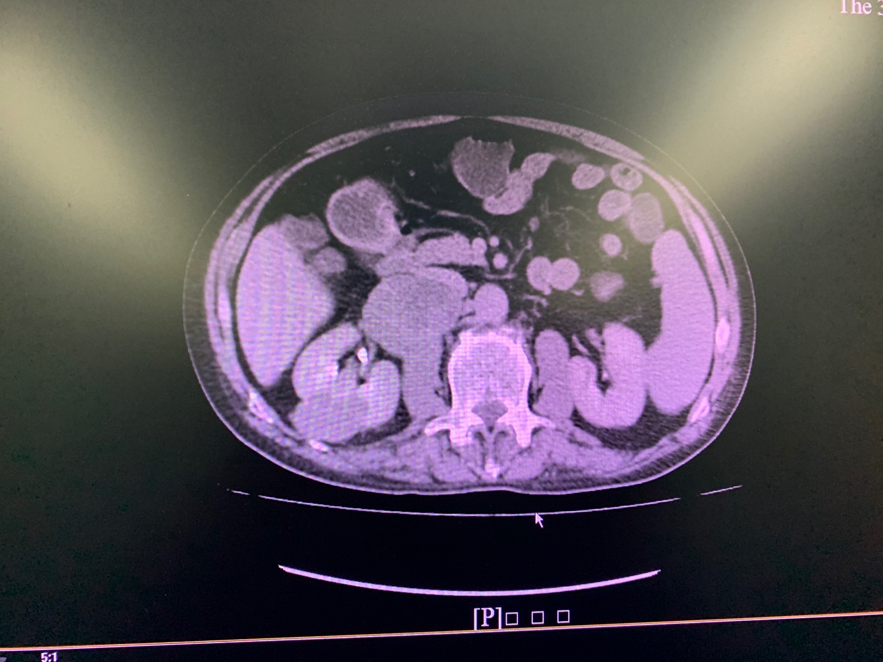3d动画演示腹腔镜辅助手术,3d动画演示腹腔镜切除回盲部肿瘤