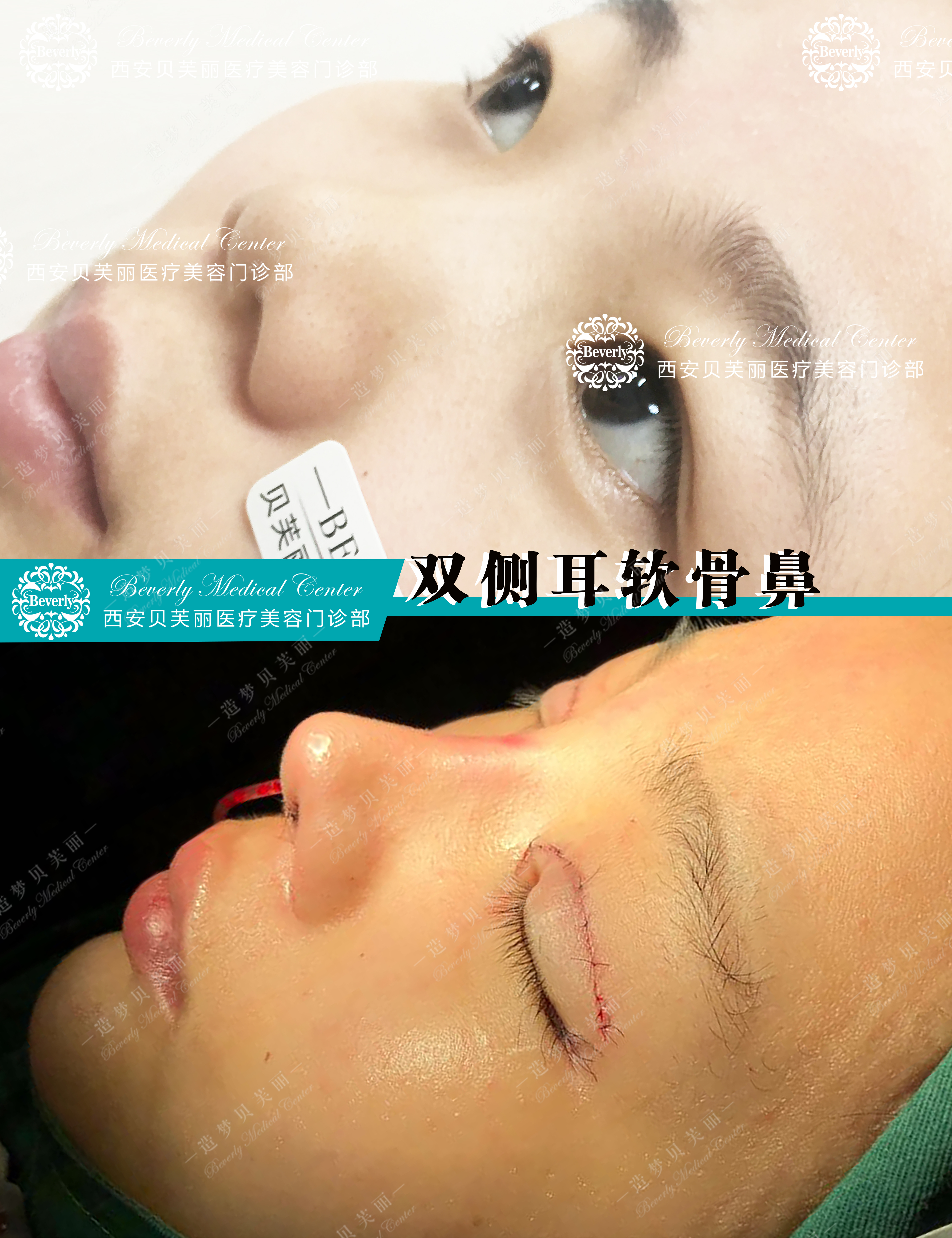 隆鼻术后一个月内可以重新修复吗,专家讲解隆鼻修复手术效果