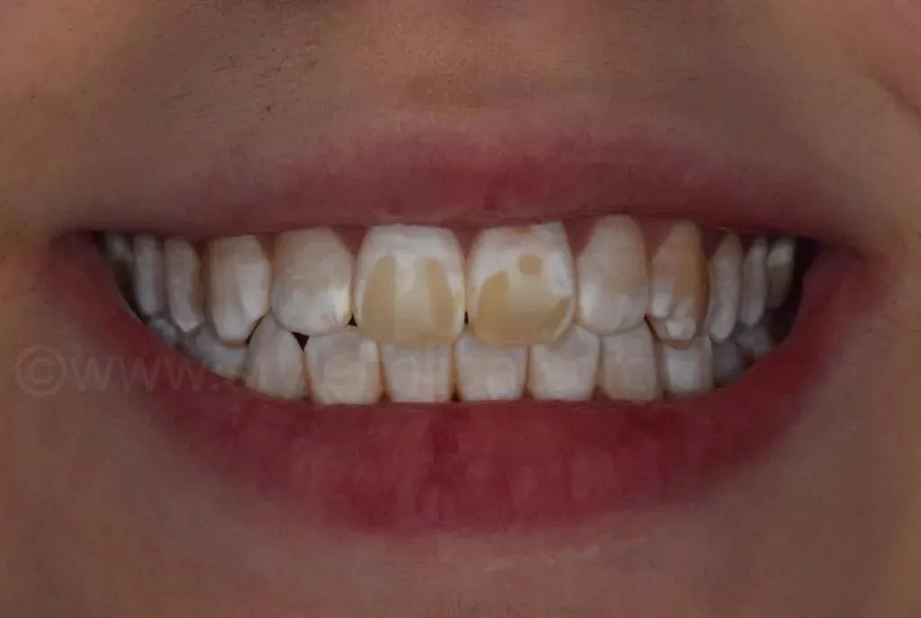 牙齿上有白斑是缺氟还是氟多了,儿童新长的牙有白斑黄斑会烂掉吗