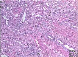 直肠癌放化疗后两年未复发,直肠癌术后放化疗有复发的吗