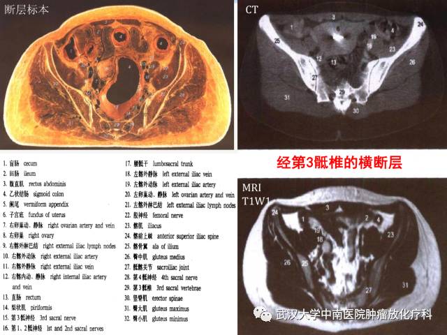 女性盆腔解剖与断层影像