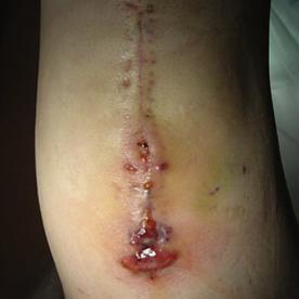 膝关节置换术后伤口渗液,膝关节置换后伤口渗出怎么办