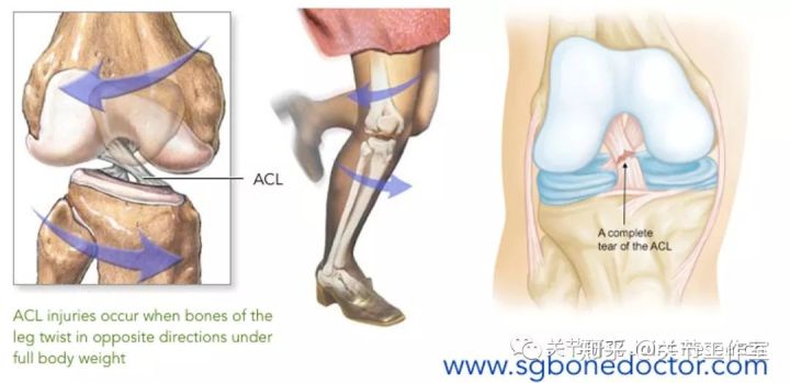 前交叉韧带断裂为什么没评上伤残,前交叉韧带断裂有什么症状