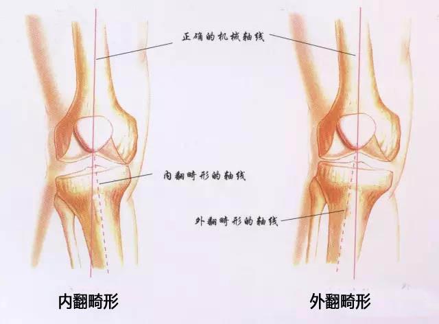 儿童膝内翻去哪里治疗,膝内翻如何矫正儿童