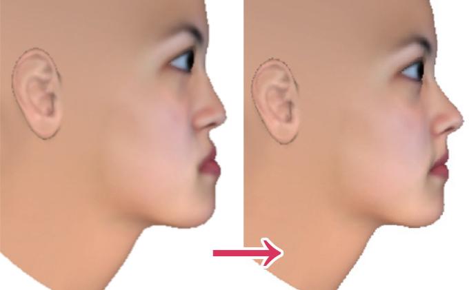 骨性地包天不做正颌手术最好方法,骨性地包天不做手术可矫正吗