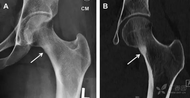 值夜班急救措施,放射科容易漏诊的骨折