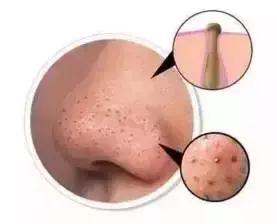 皮肤粗糙毛孔粗大,毛孔粗大黑头顽固