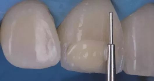 乳牙磕瓜子恒牙为什么变瓜子牙了,爱嗑瓜子