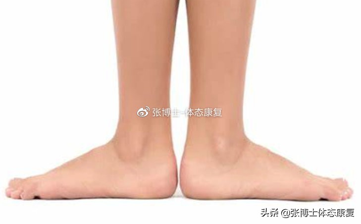 「体态矫正」怎样矫正鸭子步