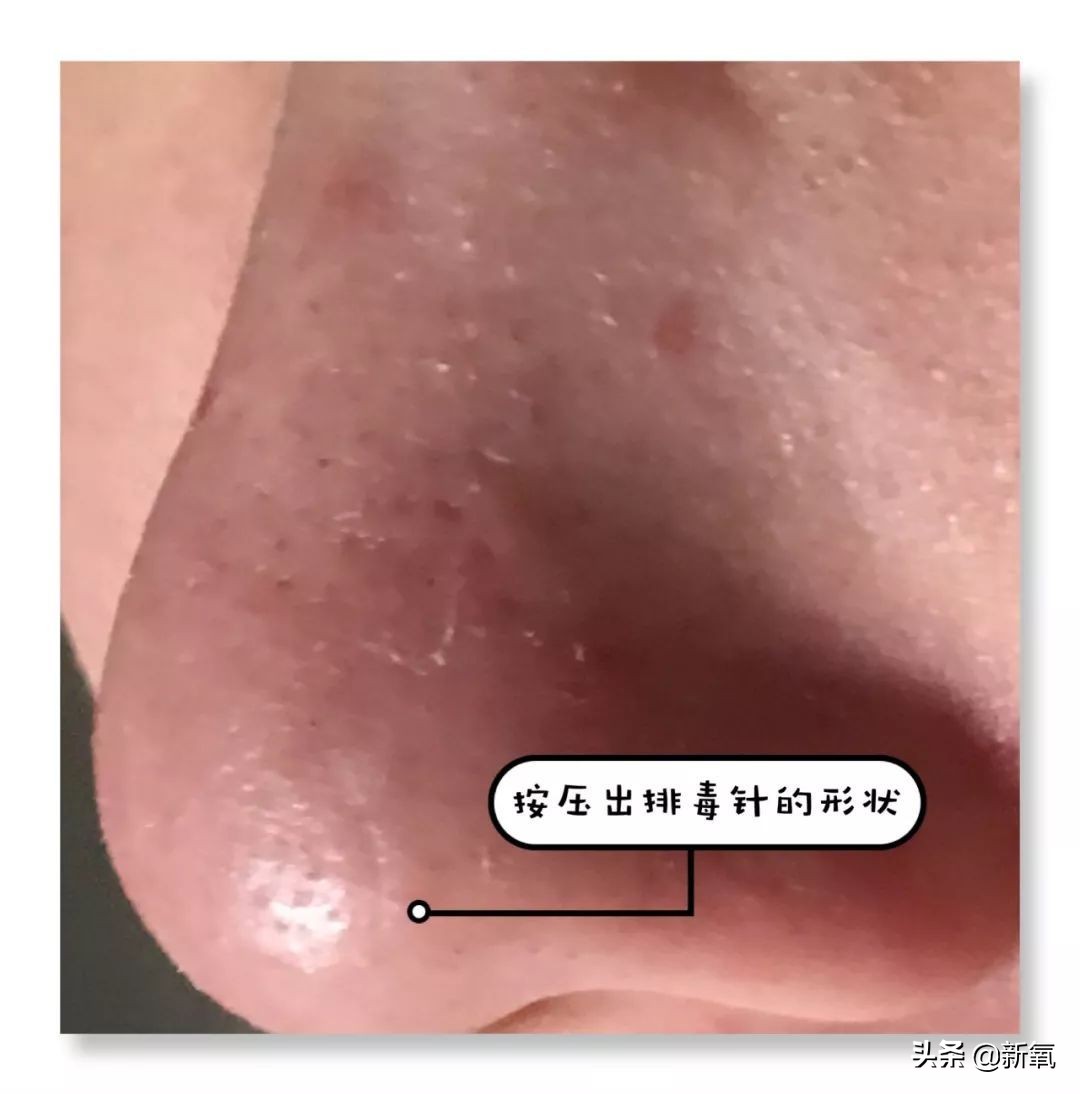 目前有真正去黑头的方法,最近超火的去黑头