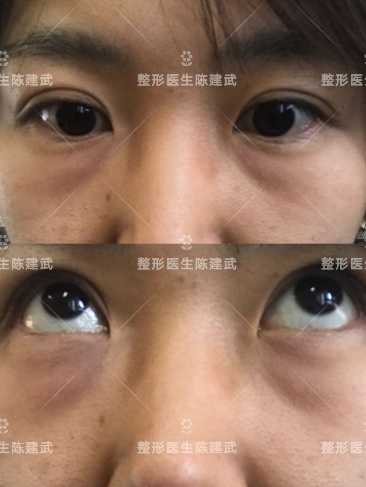 医生我想割眼袋，适合内切还是外切？不妨看看这篇文章