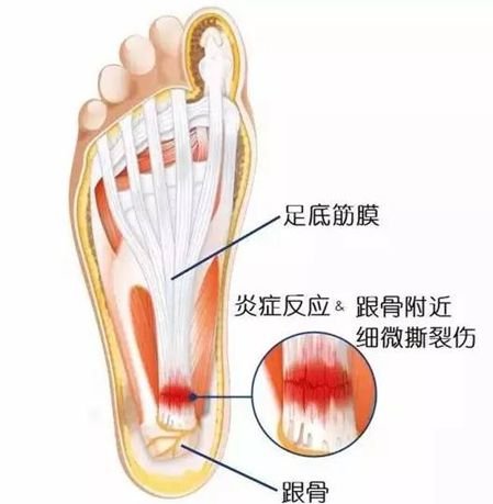 脚后跟长骨刺要不要紧,脚后跟长骨刺可以打封闭吗