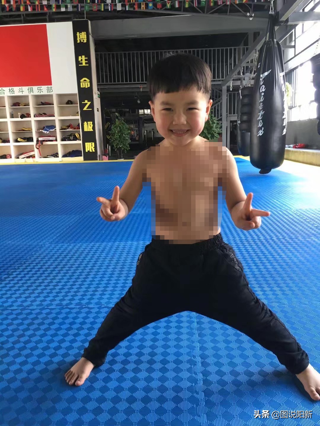 肿瘤儿童化疗期间脑萎缩,化疗后脑萎缩变傻了