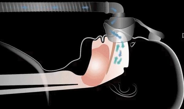 呼吸机治疗呼吸暂停原理,睡眠呼吸暂停综合征呼吸机参数