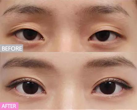 不建议做双眼皮的三种情况,为什么不建议做双眼皮