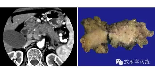 胰腺尾部肿块怎么判断,胰腺精准治疗