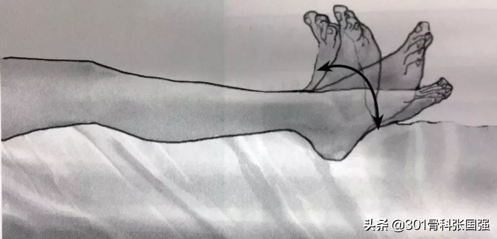 膝关节置换后血栓如何康复训练,膝关节置换后预防血栓的药吃多久
