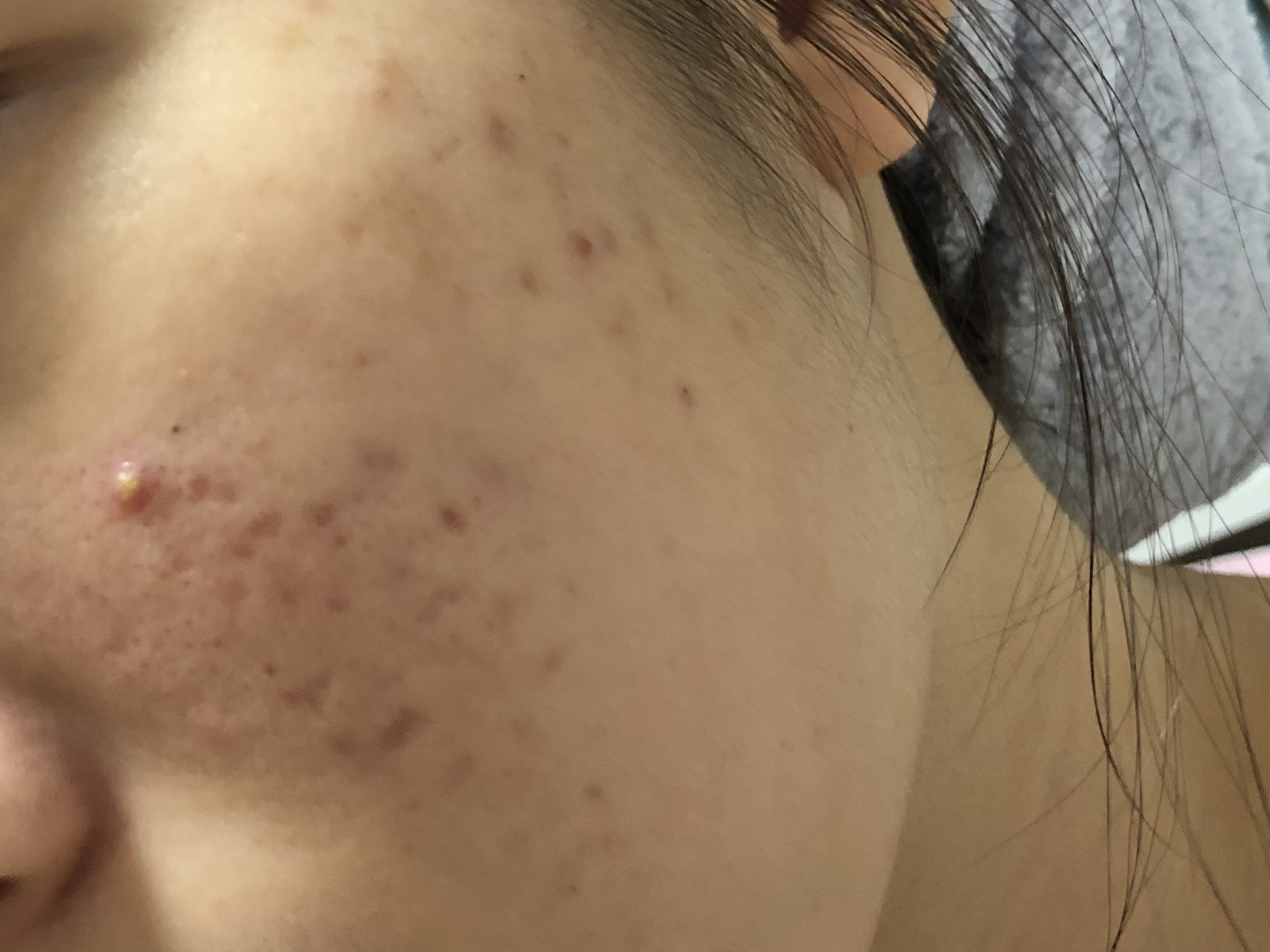 17岁的孩子身上脸上长了好多痘痘,17岁女孩脸上长好多痘痘怎么办