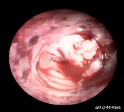 球囊扩张血肿怎么办,神经内镜辅助脑内血肿清除