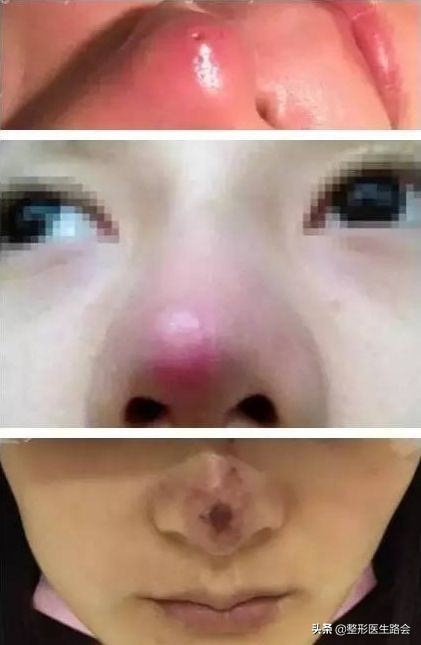 为什么不建议做线雕手术,为什么不推荐做线雕鼻