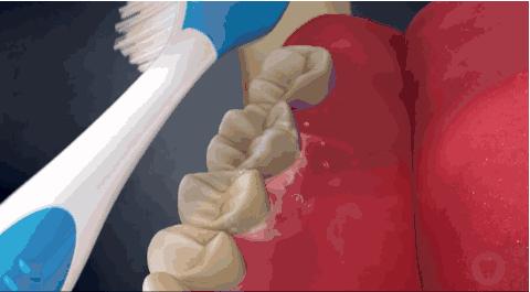 牙结石掉下来然后又长起来了,牙结石长出来了口臭