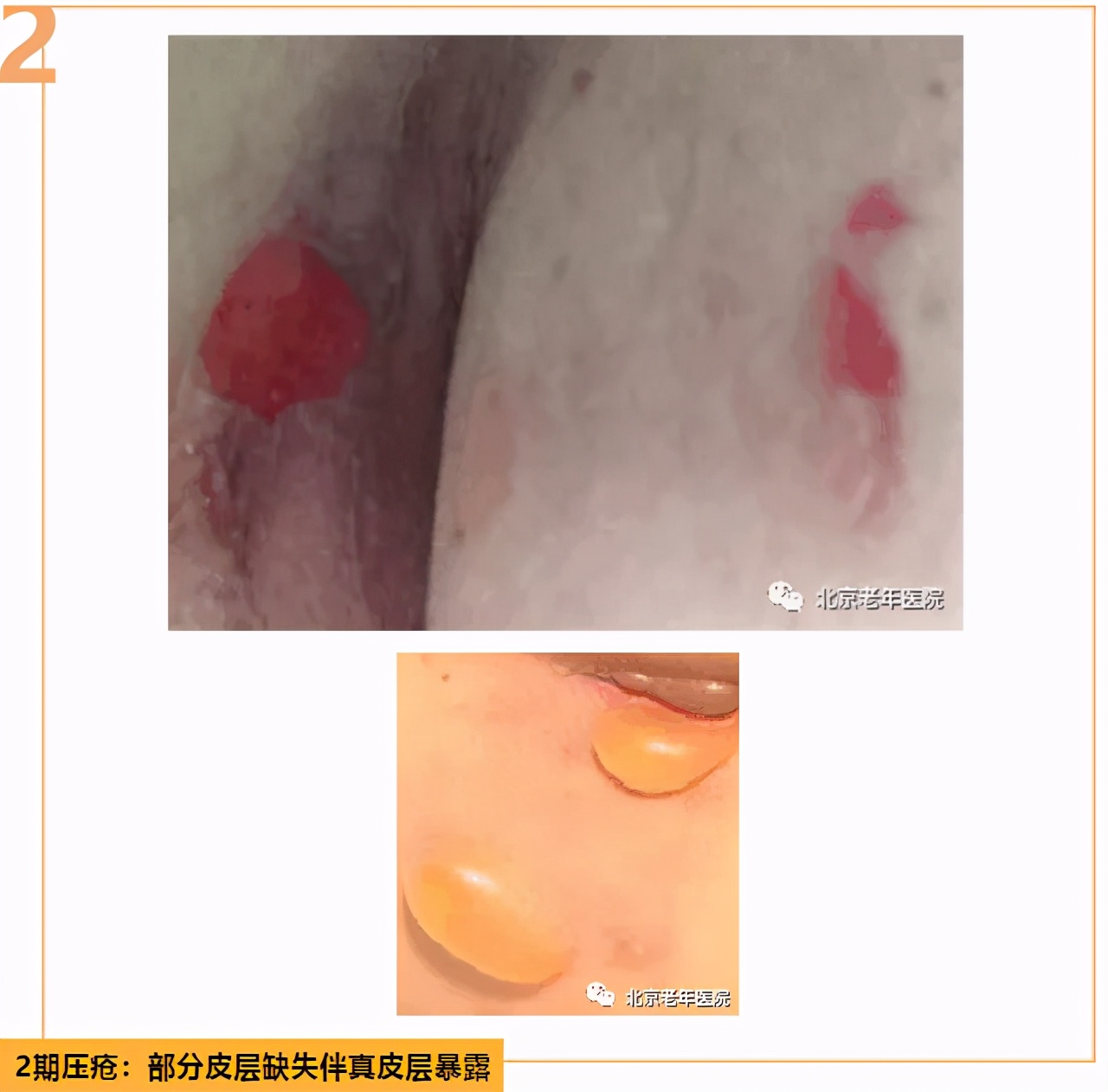 老年人防压疮的饮食照护原则,三度压疮老年人的家庭照护