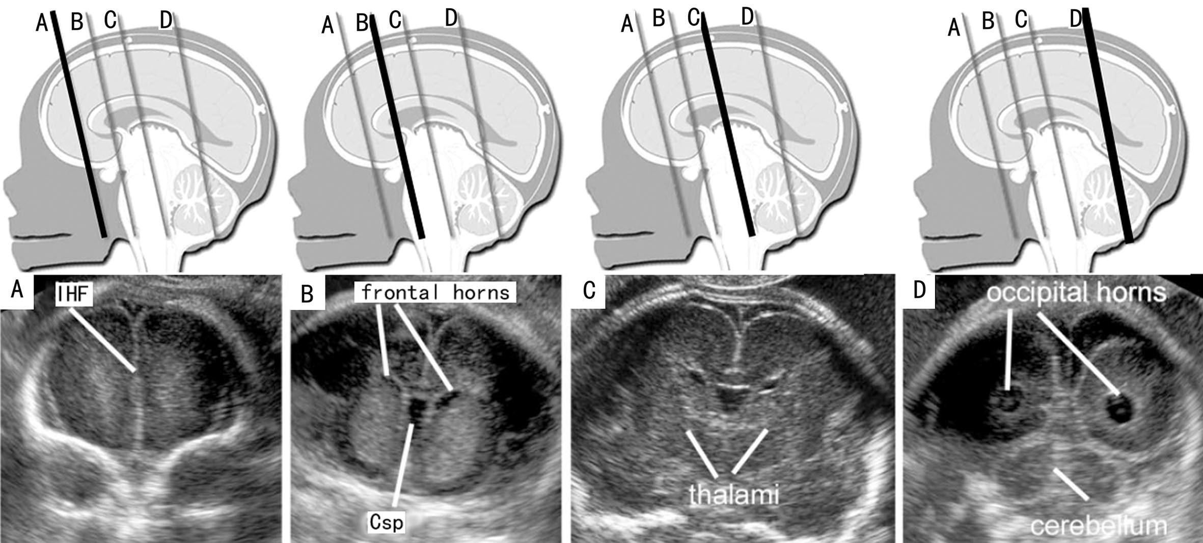 孕期头部彩超查什么,孕期检查胎儿头部有一个地方宽