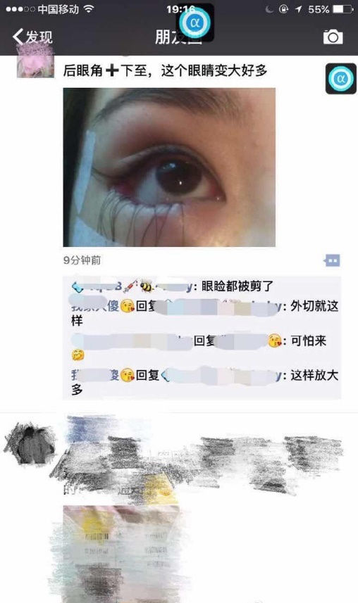 下三白眼长大后会改善吗,下三白眼的人如何手术矫正
