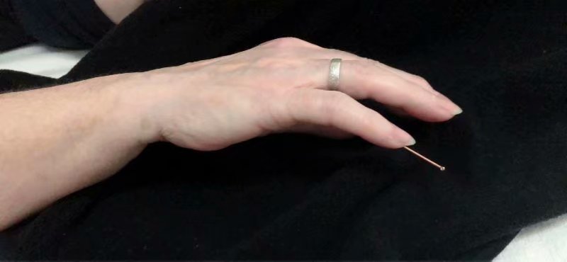 眼睛干涩的治疗（针下立竿见影）